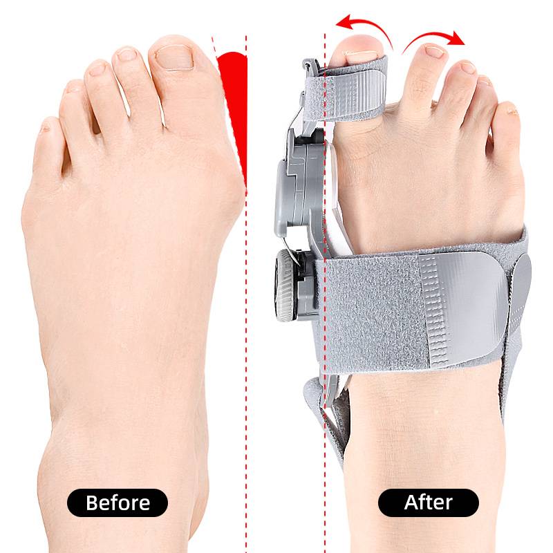Adjustable Bunion Corrector with Hinge Joint and Silicone Padding, Universal Size