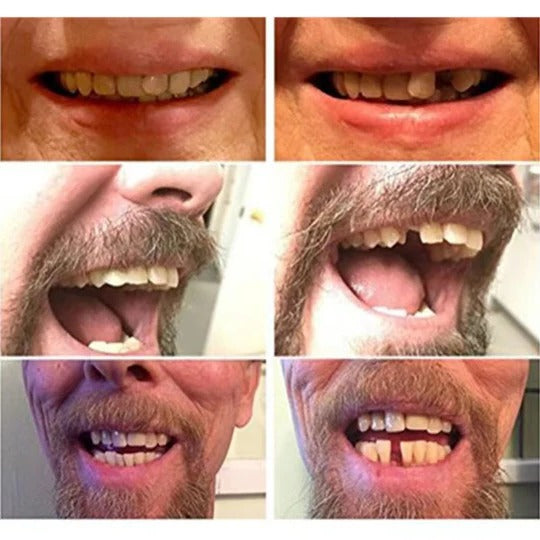 Removable Teeth Cover with Slip-On Design and Cosmetic Concealment for Uniform Smile